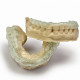 SLA Printed Splints SLA Printed Splints